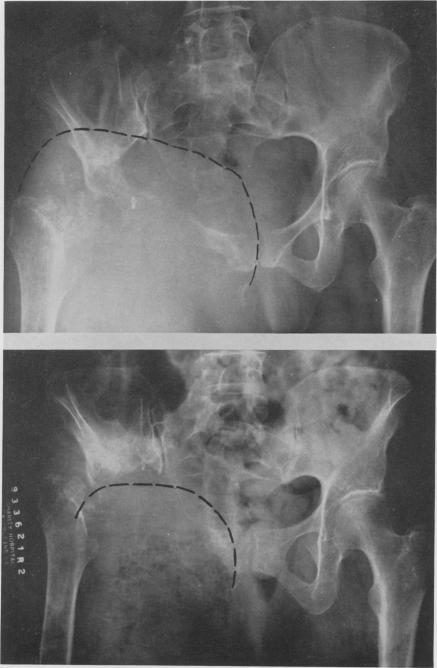 https://cdn.ncbi.nlm.nih.gov/pmc/blobs/9dcd/1450870/1c3179da4659/annsurg01228-0132-a.jpg