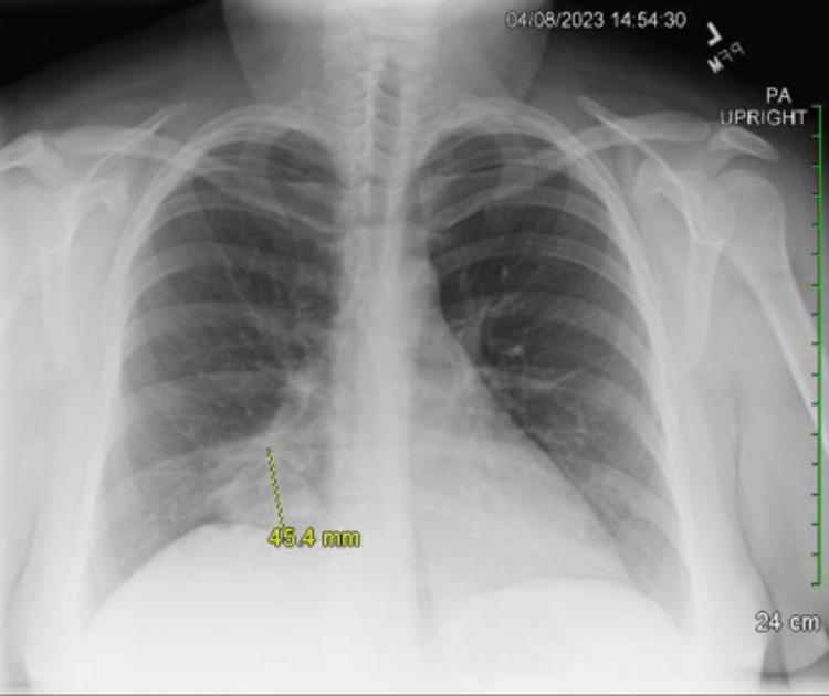 https://cdn.ncbi.nlm.nih.gov/pmc/blobs/9e2e/10548491/acdaf0feb0d4/cureus-0015-00000046411-i02.jpg