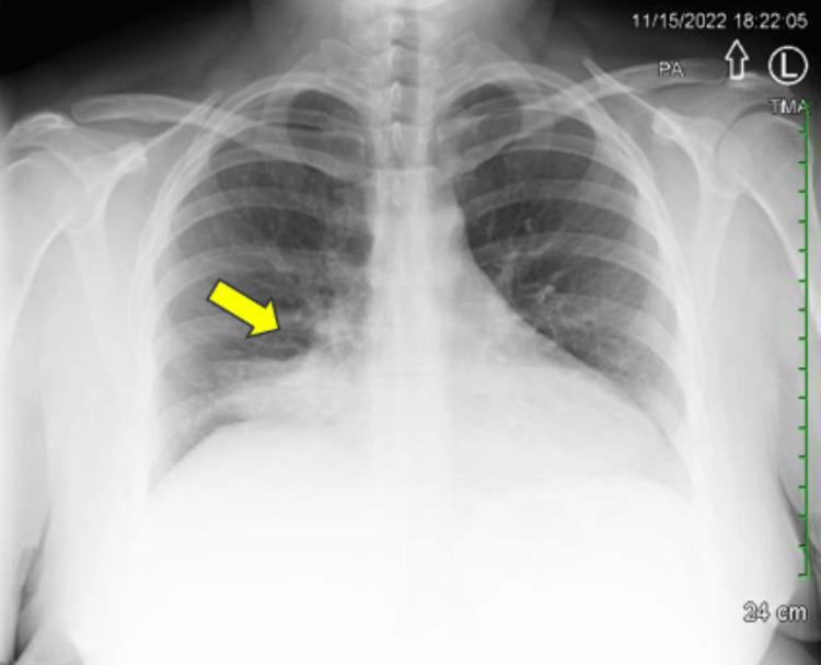 https://cdn.ncbi.nlm.nih.gov/pmc/blobs/9e2e/10548491/ba041f46238e/cureus-0015-00000046411-i01.jpg