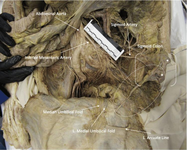 https://cdn.ncbi.nlm.nih.gov/pmc/blobs/9e3f/12034318/048166c6921a/cureus-0017-00000081366-i01.jpg