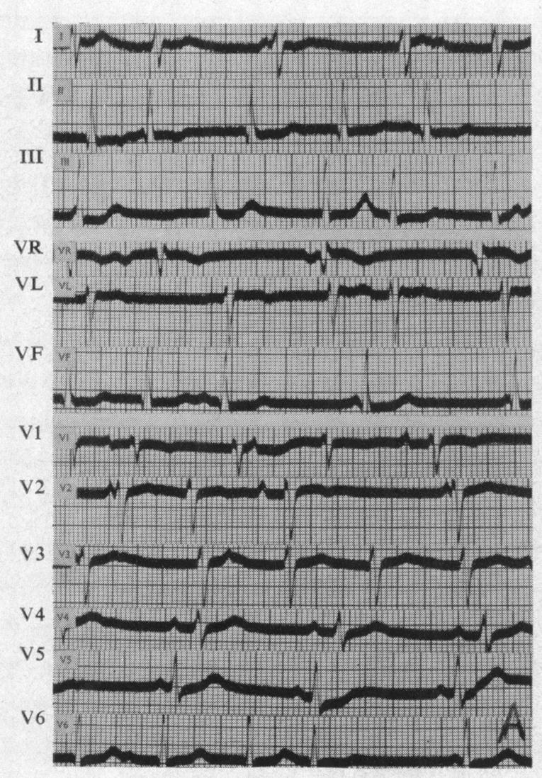 https://cdn.ncbi.nlm.nih.gov/pmc/blobs/9e9a/1017650/558d1524fe54/brheartj00367-0086-a.jpg