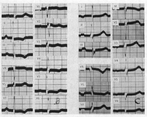 https://cdn.ncbi.nlm.nih.gov/pmc/blobs/9e9a/1017650/a2de1fcaf8e9/brheartj00367-0086-b.jpg