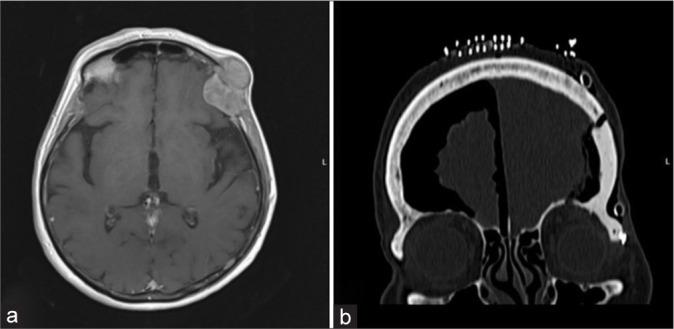 https://cdn.ncbi.nlm.nih.gov/pmc/blobs/9eca/10927182/de5afc2e3ba1/SNI-15-39-g003.jpg