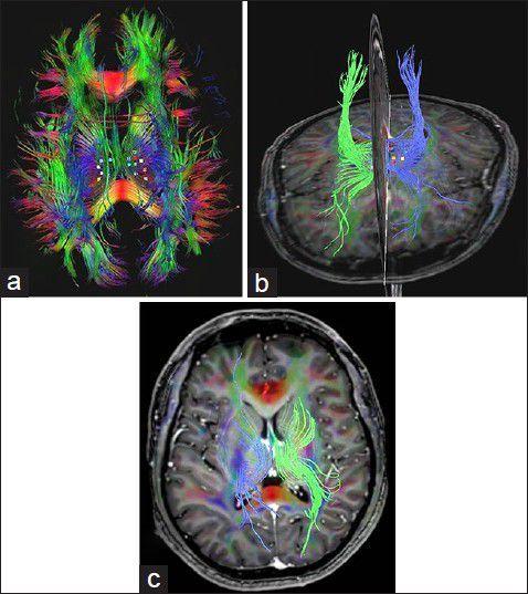 https://cdn.ncbi.nlm.nih.gov/pmc/blobs/9ece/4228496/5e3c460227bd/SNI-5-151-g002.jpg