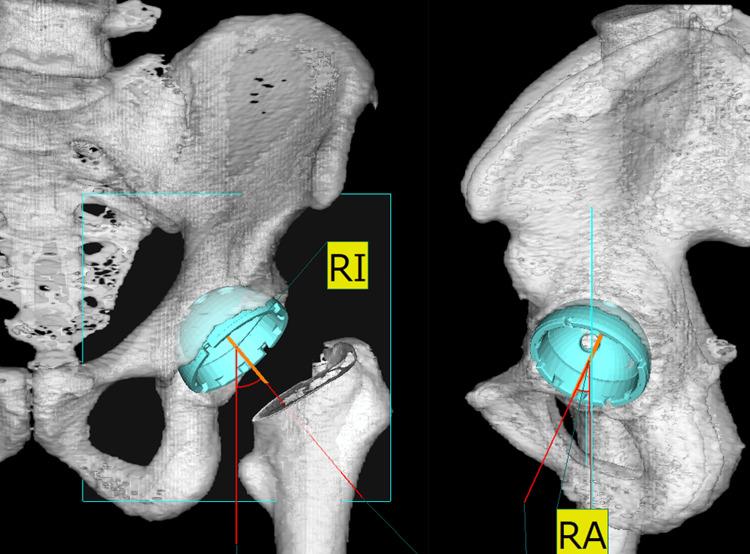 https://cdn.ncbi.nlm.nih.gov/pmc/blobs/9edf/11516148/f81d7fe3c62f/cureus-0016-00000070390-i01.jpg