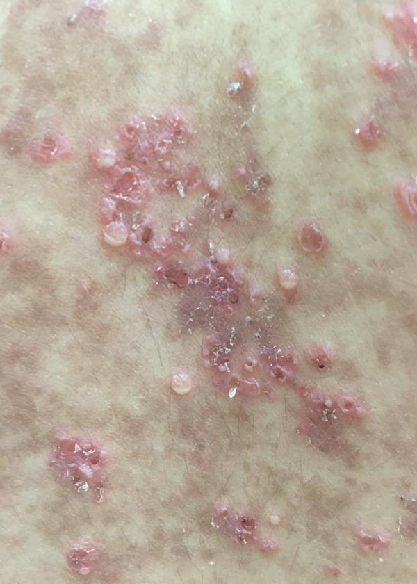 https://cdn.ncbi.nlm.nih.gov/pmc/blobs/9f0e/5871376/10429c4bebab/abd-93-01-0116-g02.jpg