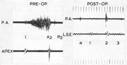 https://cdn.ncbi.nlm.nih.gov/pmc/blobs/9f97/1018194/912bdb6ae862/brheartj00346-0090-c.jpg