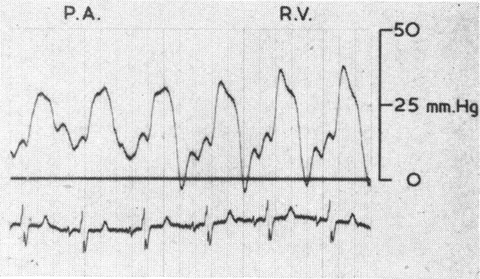 https://cdn.ncbi.nlm.nih.gov/pmc/blobs/9f97/1018194/970238274366/brheartj00346-0090-b.jpg