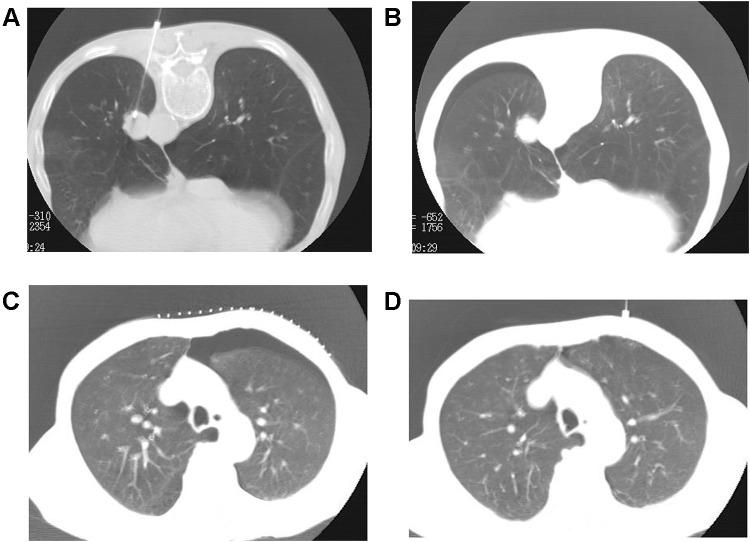 https://cdn.ncbi.nlm.nih.gov/pmc/blobs/9fca/8001193/0c089e1e3fac/IJGM-14-1013-g0002.jpg