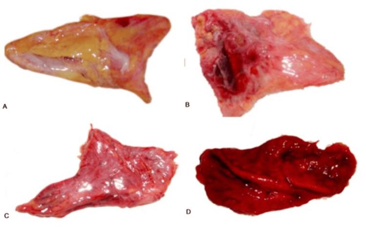 https://cdn.ncbi.nlm.nih.gov/pmc/blobs/9fe2/10811436/94348fffebe8/cureus-0015-00000051175-i01.jpg