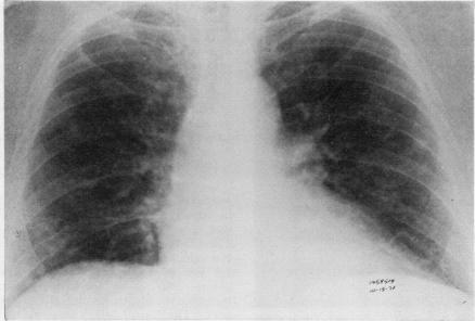 https://cdn.ncbi.nlm.nih.gov/pmc/blobs/a01b/470264/a68d1a458b4f/thorax00140-0059-b.jpg