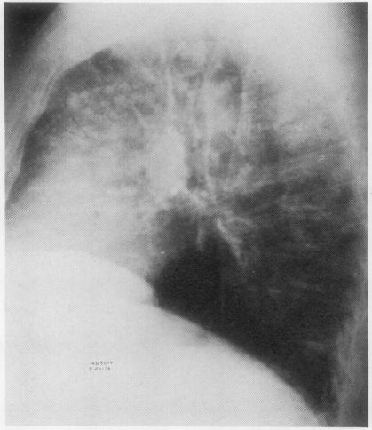https://cdn.ncbi.nlm.nih.gov/pmc/blobs/a01b/470264/e4d3ae2ef8a9/thorax00140-0060-b.jpg