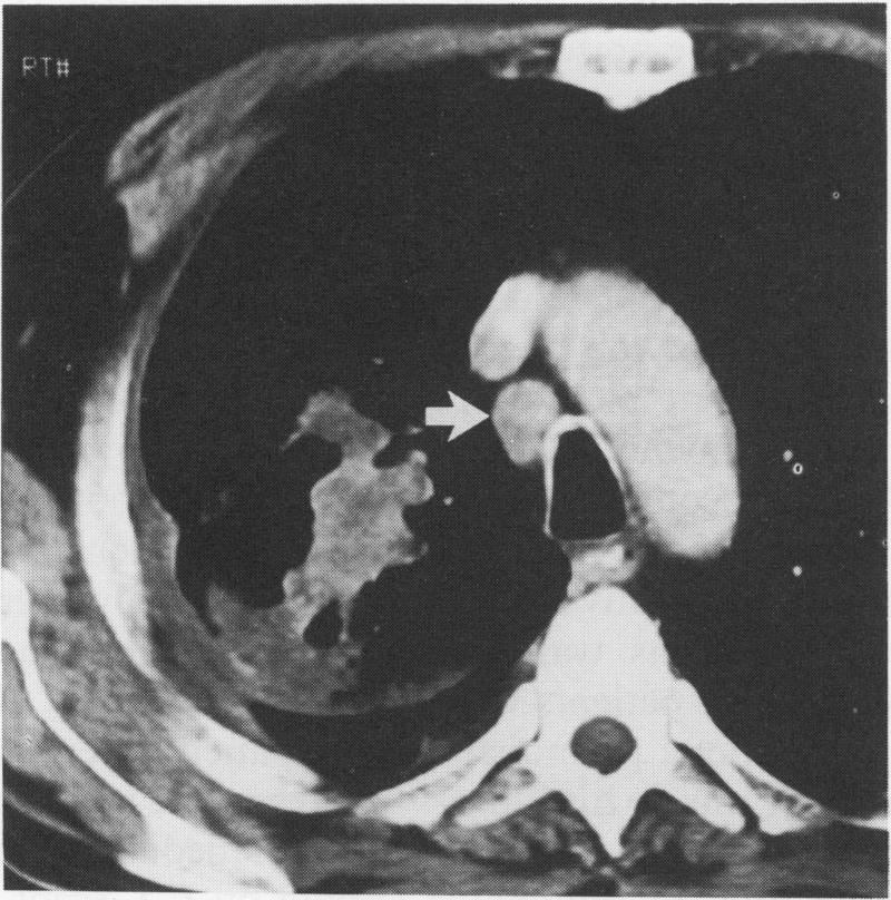 https://cdn.ncbi.nlm.nih.gov/pmc/blobs/a0e0/475227/83186f34bd4e/thorax00302-0021-b.jpg