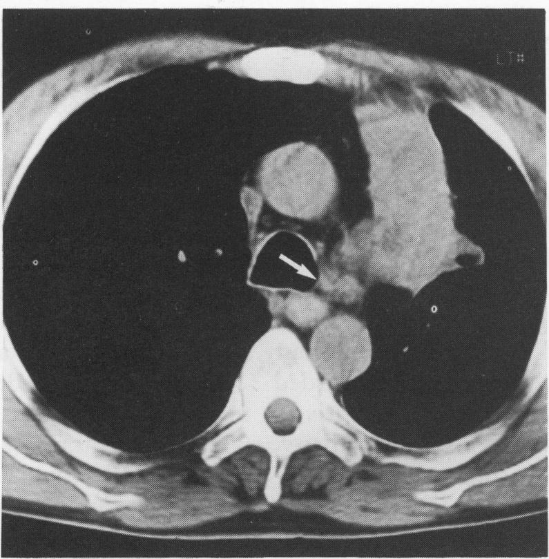 https://cdn.ncbi.nlm.nih.gov/pmc/blobs/a0e0/475227/99b3c49167e0/thorax00302-0021-a.jpg