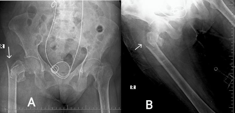 https://cdn.ncbi.nlm.nih.gov/pmc/blobs/a132/11220731/67d031480eac/cureus-0016-00000061562-i01.jpg