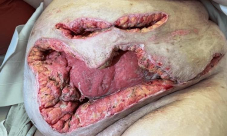 https://cdn.ncbi.nlm.nih.gov/pmc/blobs/a169/11285656/67b82578510e/cureus-0016-00000063470-i04.jpg