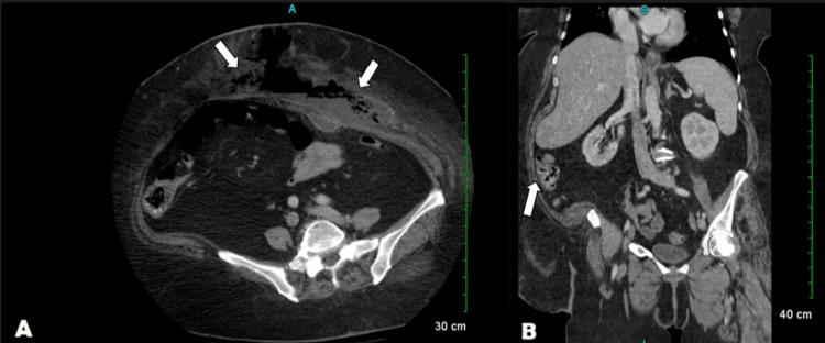 https://cdn.ncbi.nlm.nih.gov/pmc/blobs/a169/11285656/c5c41cb07003/cureus-0016-00000063470-i01.jpg
