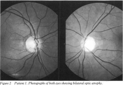 https://cdn.ncbi.nlm.nih.gov/pmc/blobs/a1e4/504470/8852172d886a/brjopthal00039-0052-a.jpg