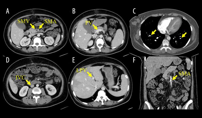 https://cdn.ncbi.nlm.nih.gov/pmc/blobs/a237/11991407/714908e76d7b/amjcaserep-26-e947094-g005.jpg
