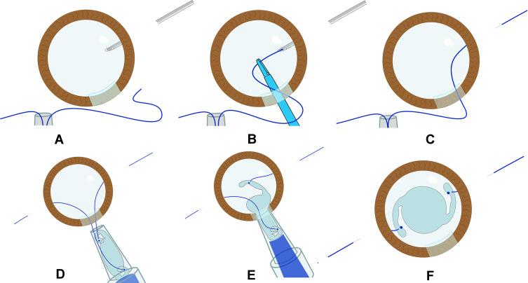 https://cdn.ncbi.nlm.nih.gov/pmc/blobs/a23b/7549876/0b667fb39063/OPTH-14-3131-g0002.jpg