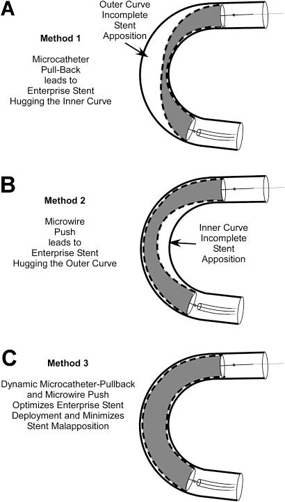 https://cdn.ncbi.nlm.nih.gov/pmc/blobs/a240/3212648/5010e6011447/neurintsurg4499fig3.jpg