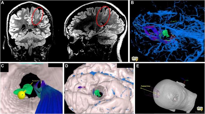https://cdn.ncbi.nlm.nih.gov/pmc/blobs/a25f/11809979/0bc21d7f988c/neuopen-4-e00038-g003.jpg