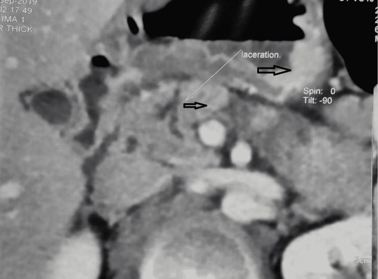 https://cdn.ncbi.nlm.nih.gov/pmc/blobs/a2be/9168422/907608713357/cureus-0014-00000024793-i02.jpg
