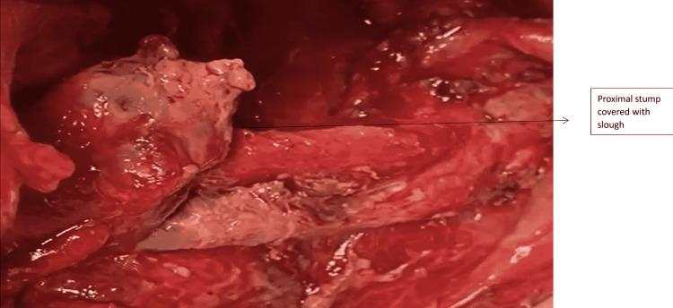 https://cdn.ncbi.nlm.nih.gov/pmc/blobs/a2be/9168422/ff6e8ed5c0da/cureus-0014-00000024793-i11.jpg