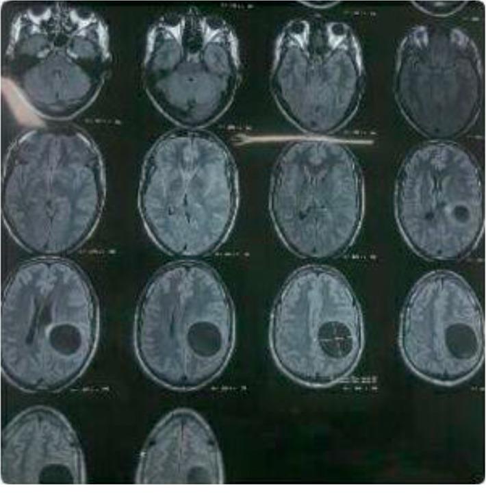 https://cdn.ncbi.nlm.nih.gov/pmc/blobs/a32b/7066420/68f39f404ef7/CRIID2020-1754231.001.jpg