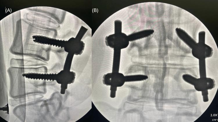 https://cdn.ncbi.nlm.nih.gov/pmc/blobs/a343/12033040/cb48a06030f3/cureus-0017-00000081297-i04.jpg