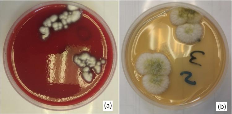 https://cdn.ncbi.nlm.nih.gov/pmc/blobs/a3bb/10788054/d27d23c1a0f2/OPTH-18-85-g0004.jpg