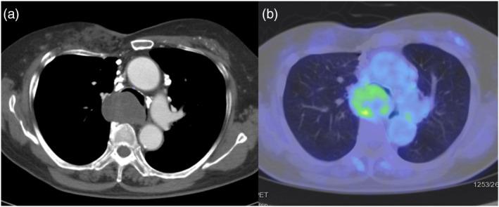 https://cdn.ncbi.nlm.nih.gov/pmc/blobs/a3dc/11219282/1738e377a5da/TCA-15-1533-g003.jpg
