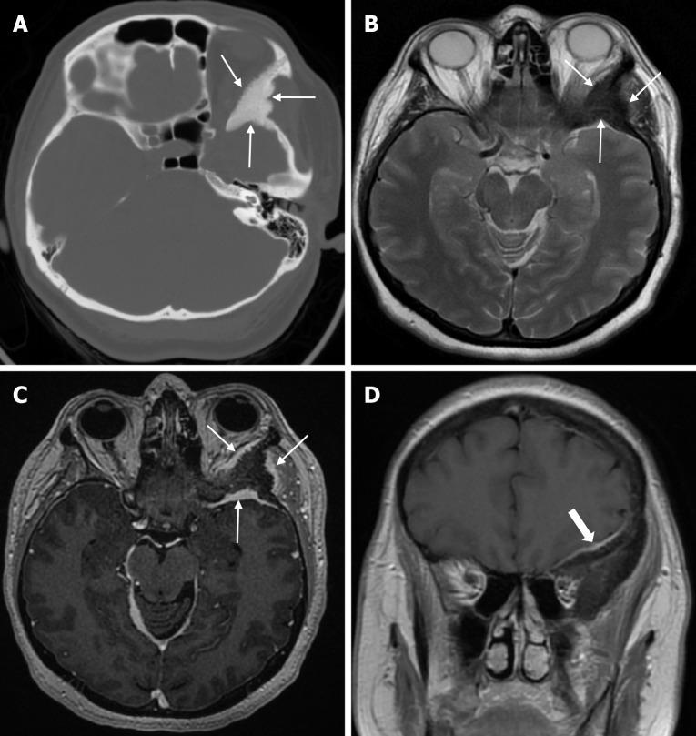https://cdn.ncbi.nlm.nih.gov/pmc/blobs/a405/12210201/fb93472c293b/wjr-17-6-107776-g021.jpg
