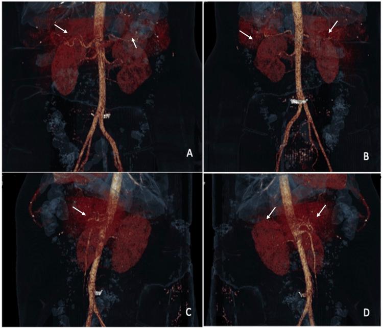 https://cdn.ncbi.nlm.nih.gov/pmc/blobs/a43b/12422985/ce299919ddc3/cureus-0017-00000089848-i03.jpg