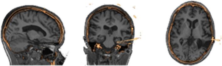 https://cdn.ncbi.nlm.nih.gov/pmc/blobs/a484/11405301/b22b3a69b411/fninf-18-1465231-g002.jpg
