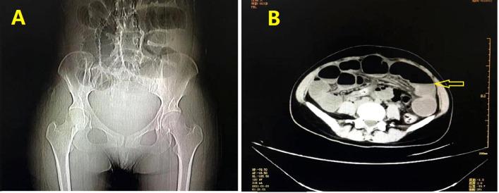 https://cdn.ncbi.nlm.nih.gov/pmc/blobs/a4ca/9905710/cdc09b43964a/fonc-13-1066153-g001.jpg