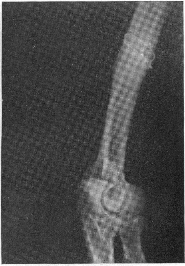 https://cdn.ncbi.nlm.nih.gov/pmc/blobs/a4cb/1391244/75453031105d/annsurg00543-0144-d.jpg