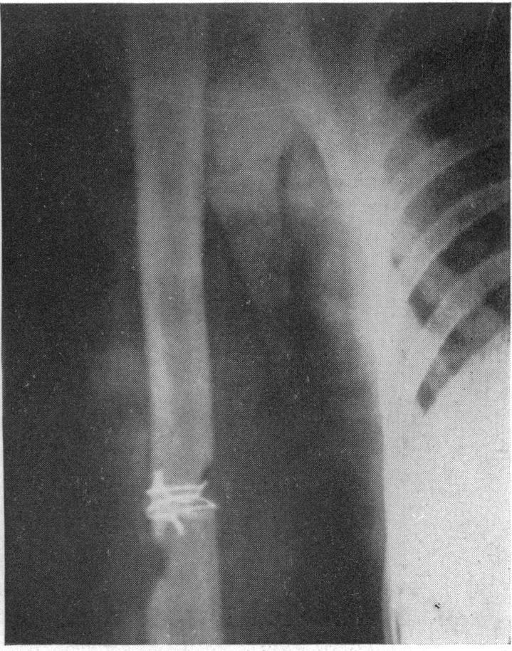 https://cdn.ncbi.nlm.nih.gov/pmc/blobs/a4cb/1391244/93c1a2ad5848/annsurg00543-0144-b.jpg