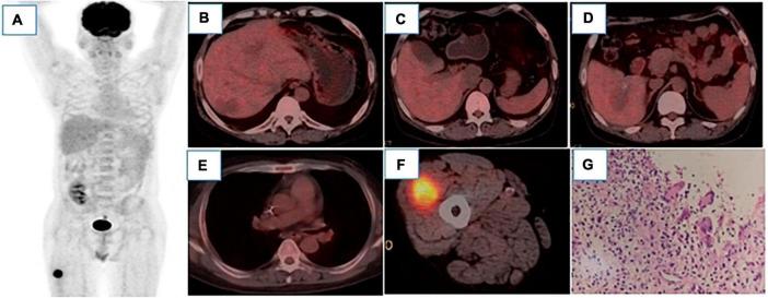 https://cdn.ncbi.nlm.nih.gov/pmc/blobs/a4f1/10869483/787191a1322f/fmed-11-1353466-g003.jpg