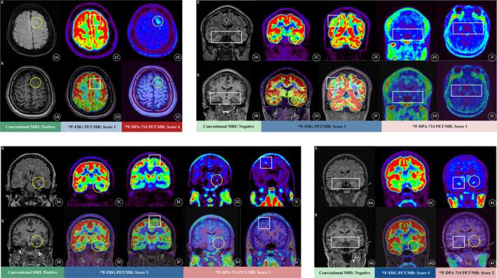 https://cdn.ncbi.nlm.nih.gov/pmc/blobs/a536/11802325/8c2125167e71/CNS-31-e70251-g002.jpg