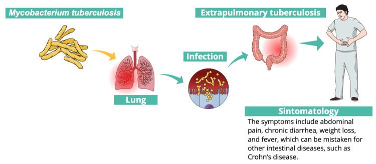 https://cdn.ncbi.nlm.nih.gov/pmc/blobs/a538/11681949/48e66c99e0ed/cureus-0016-00000076456-i01.jpg
