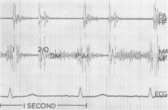 https://cdn.ncbi.nlm.nih.gov/pmc/blobs/a551/1018669/2f8156697df5/thorax00065-0068-a.jpg