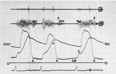 https://cdn.ncbi.nlm.nih.gov/pmc/blobs/a551/1018669/7e7304bd578f/thorax00065-0069-a.jpg