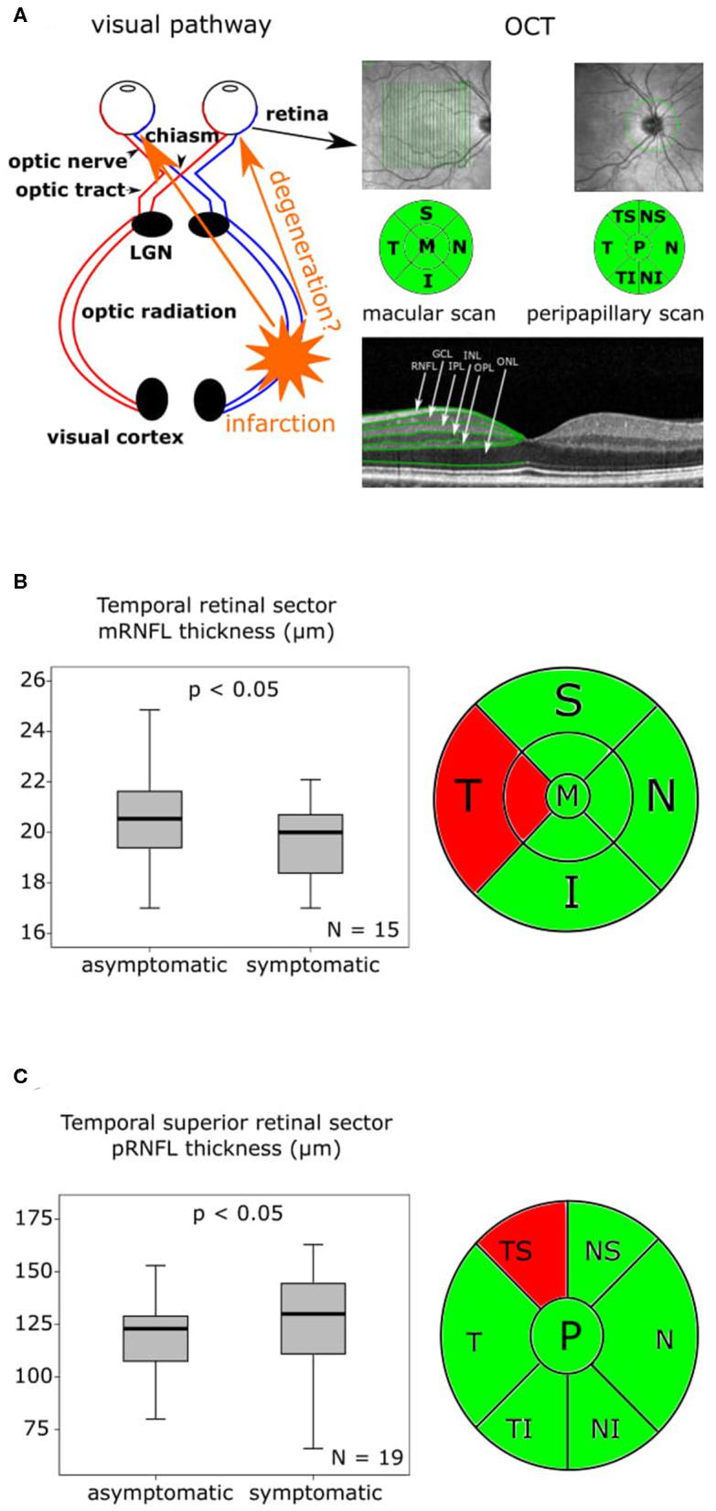 https://cdn.ncbi.nlm.nih.gov/pmc/blobs/a566/7290045/8aad31efd8c8/fneur-11-00508-g0001.jpg