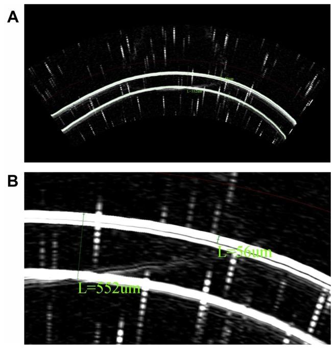 https://cdn.ncbi.nlm.nih.gov/pmc/blobs/a57b/3373227/42e66a5920c5/opth-6-789f1.jpg