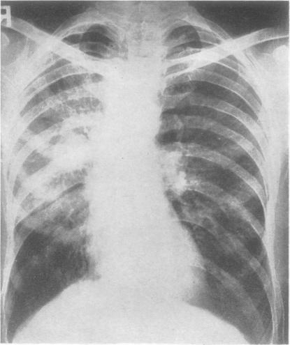 https://cdn.ncbi.nlm.nih.gov/pmc/blobs/a58e/1019236/605b0d79dc48/thorax00046-0028-a.jpg