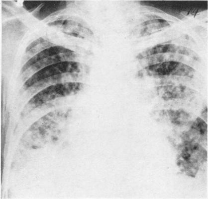 https://cdn.ncbi.nlm.nih.gov/pmc/blobs/a58e/1019236/d4dca24dbe7e/thorax00046-0025-a.jpg
