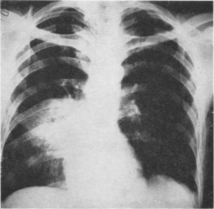 https://cdn.ncbi.nlm.nih.gov/pmc/blobs/a58e/1019236/ed3b41cdd531/thorax00046-0027-b.jpg