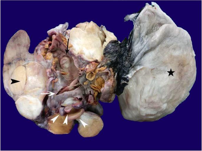 https://cdn.ncbi.nlm.nih.gov/pmc/blobs/a593/6394358/facc2495650a/autopsy-09-01e2018056-g03.jpg