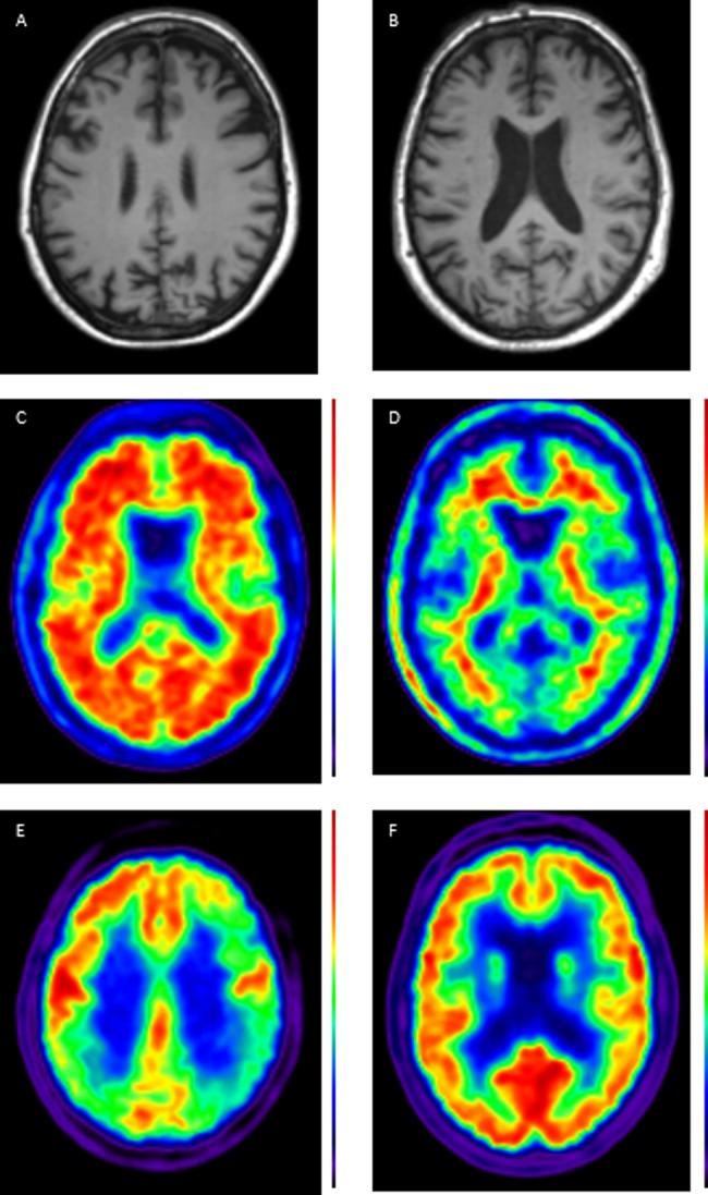 https://cdn.ncbi.nlm.nih.gov/pmc/blobs/a5a3/4335455/c600d0c8fe92/jnnp-2014-307662f01.jpg
